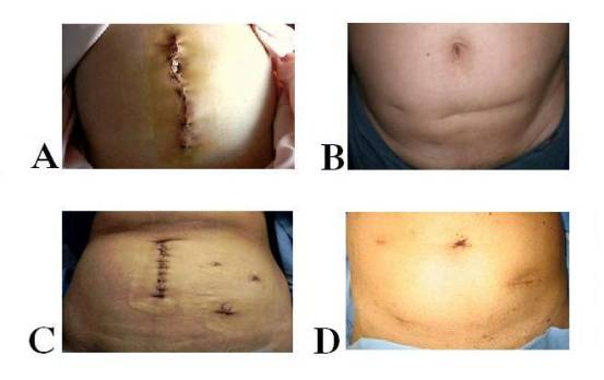 Low Anterior Resection Of The Colon